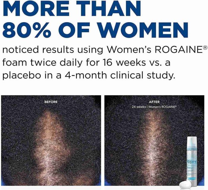 Rogaine 5% Minoxidil Foam, Topical Once-A-Day Hair Loss Treatment for Women to Regrow Fuller | Choice Wholesales