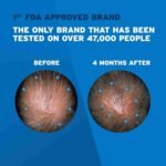 Men’s Rogaine Extra Strength 5% Minoxidil Topical Solution for Thin Hair, Hair Loss Treatment to Regrow Fuller, Thicker Hair, | Choice Wholesales